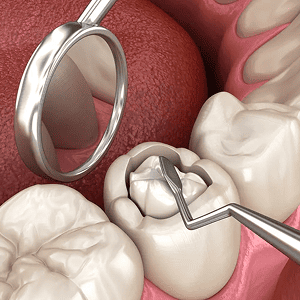 Tooth Fillings
